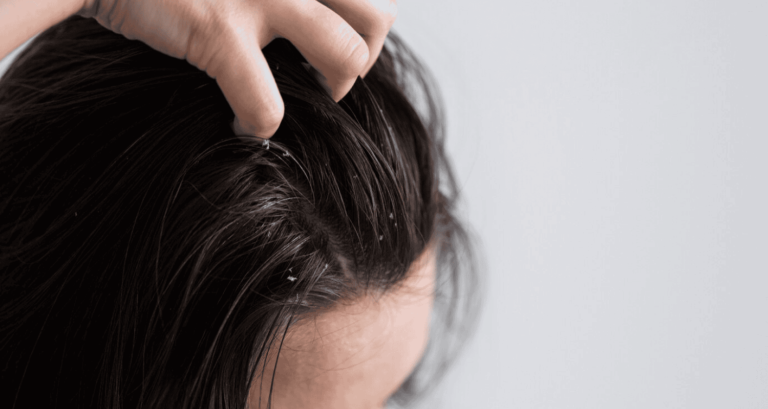 Oily Scalp